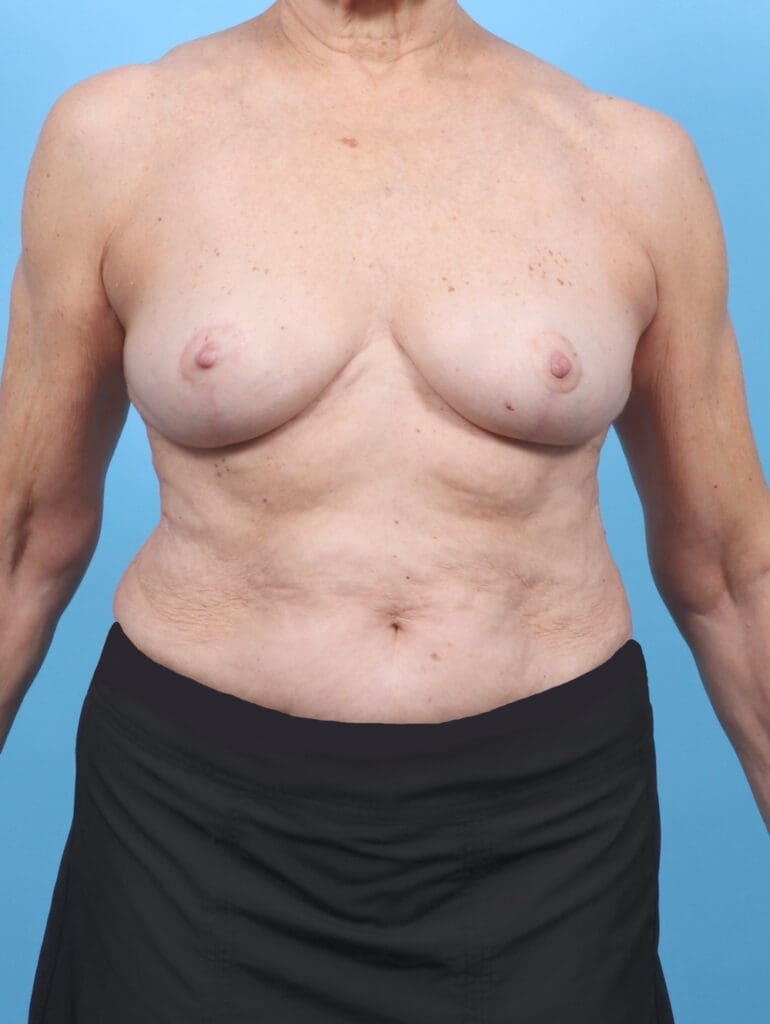 Breast Lift/Reduction w/o Implants - Case 52816 - After