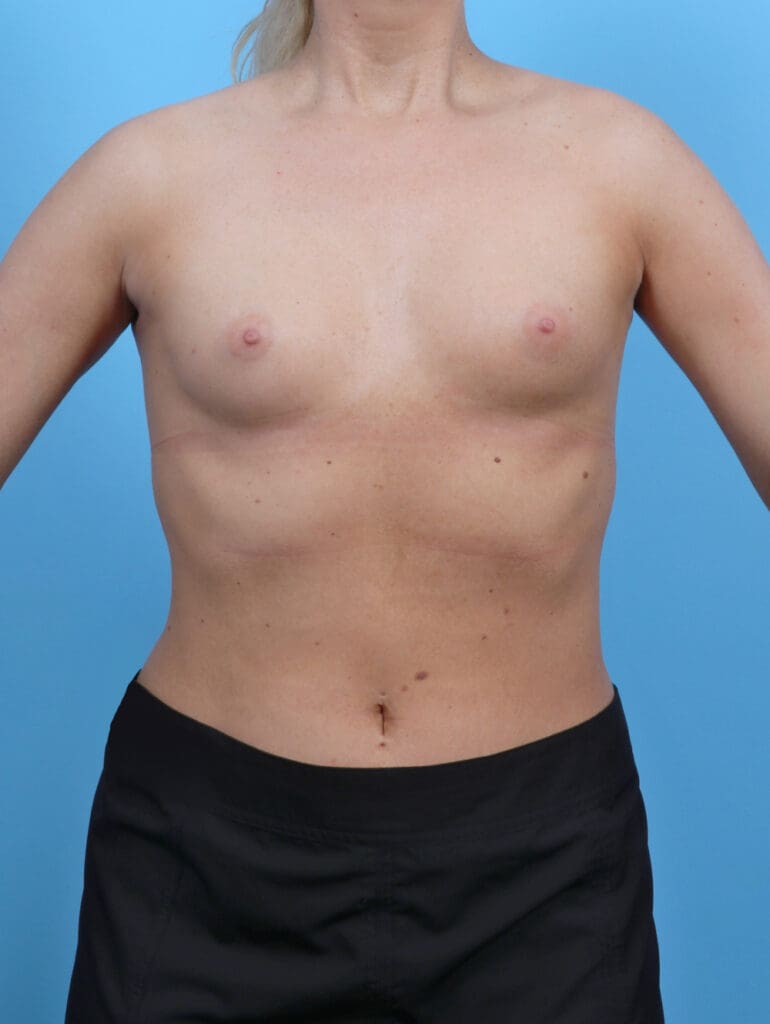 Breast Augmentation - Case 52832 - Before