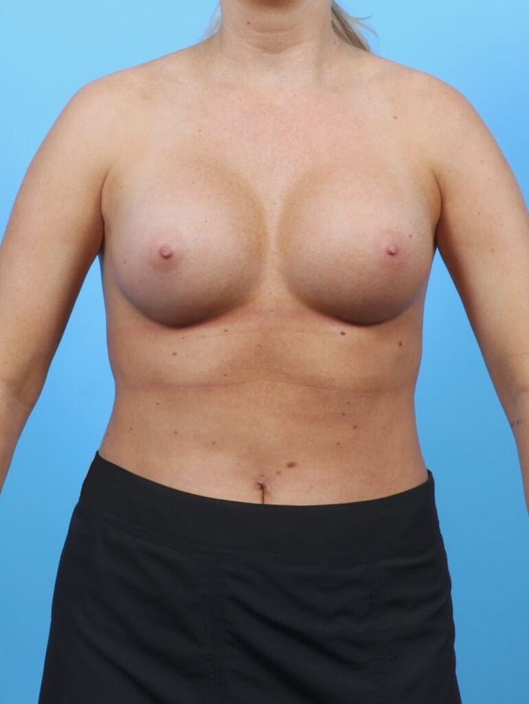 Breast Augmentation - Case 52832 - After