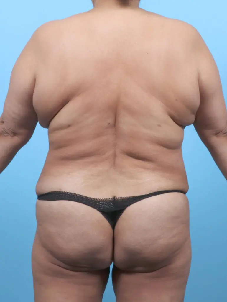 Liposuction - Case 52985 - After