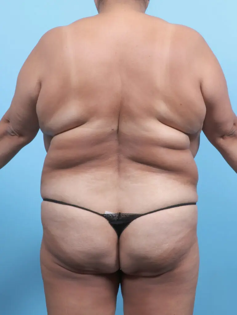 Liposuction - Case 52985 - Before