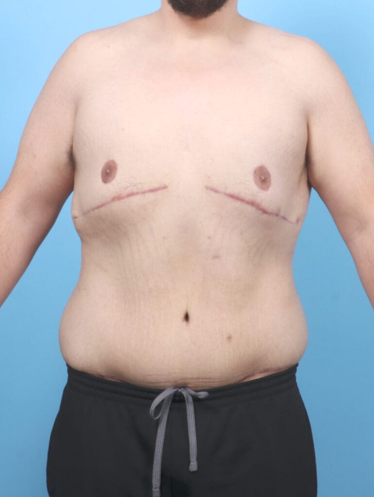 After Weight Loss - Case 53108 - After