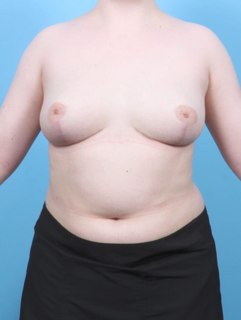 Breast Lift/Reduction w/o Implants - Case 53118 - After