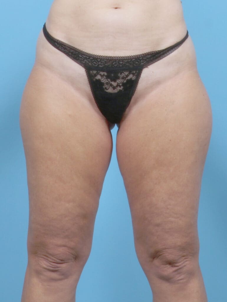Liposuction - Case 53150 - Before