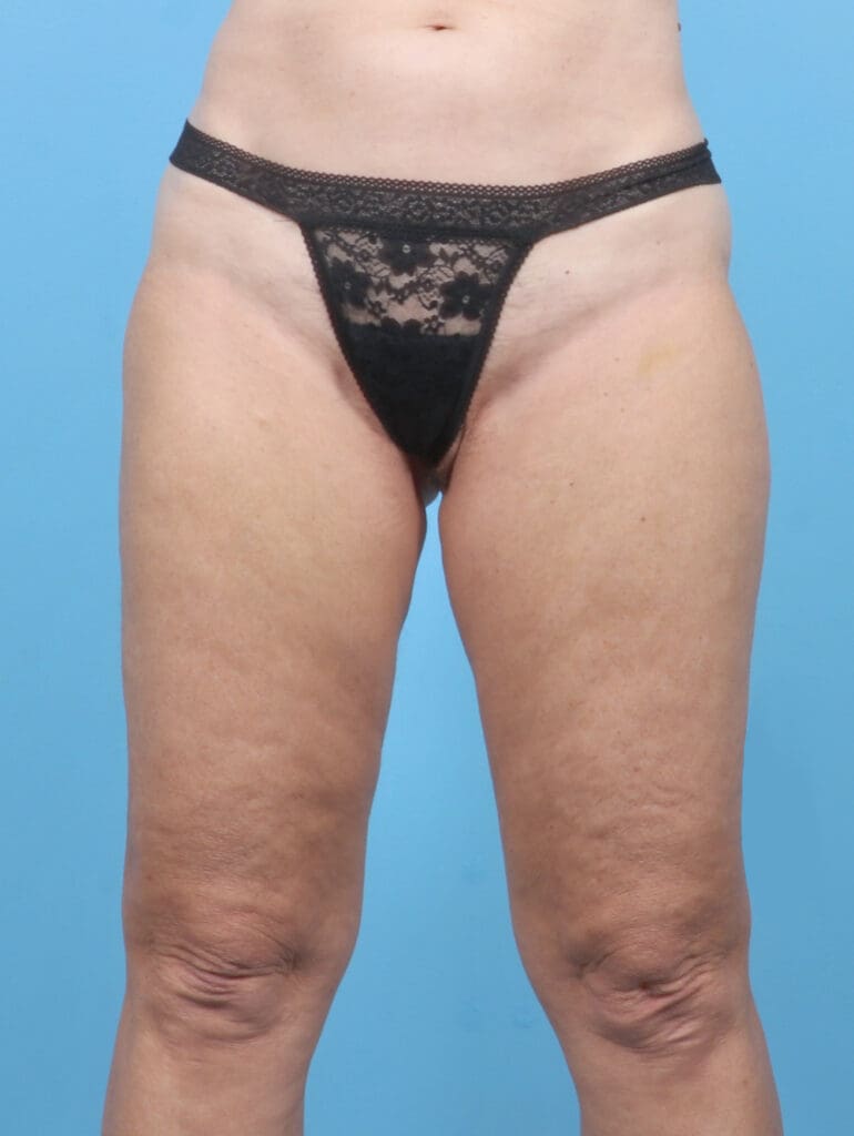 Liposuction - Case 53150 - After